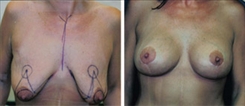 Breast Augmentation Patient Before & After Photo 1