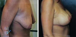 Breast Augmentation Patient Before & After Photo 1