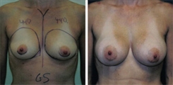 Breast Augmentation Patient Before & After Photo 1