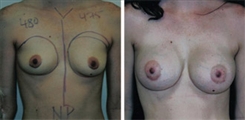 Breast Augmentation Patient Before & After Photo 1