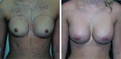 Breast Augmentation Patient Before & After Photo 1