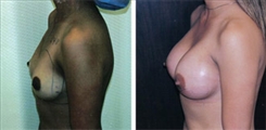 Breast Augmentation Patient Before & After Photo 1