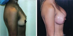 Breast Augmentation Patient Before & After Photo 1