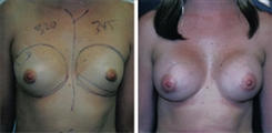 Breast Augmentation Patient Before & After Photo 1