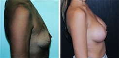 Breast Augmentation Patient Before & After Photo 1