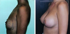 Breast Augmentation Patient Before & After Photo 1