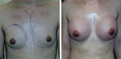 Breast Augmentation Patient Before & After Photo 1