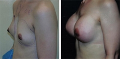 Breast Augmentation Patient Before & After Photo 1