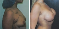 Breast Augmentation Patient Before & After Photo 1