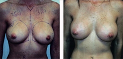 Breast Augmentation Patient Before & After Photo 1