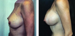 Breast Augmentation Patient Before & After Photo 1