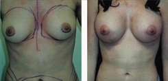 Breast Augmentation Patient Before & After Photo 1