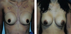 Breast Augmentation Patient Before & After Photo 1