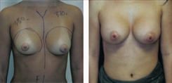 Breast Augmentation Patient Before & After Photo 1