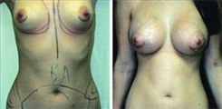 Breast Augmentation Patient Before & After Photo 1