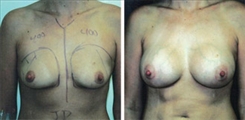 Breast Augmentation Patient Before & After Photo 1