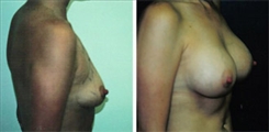 Breast Augmentation Patient Before & After Photo 1