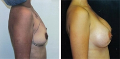 Breast Augmentation Patient Before & After Photo 1