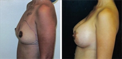 Breast Augmentation Patient Before & After Photo 1