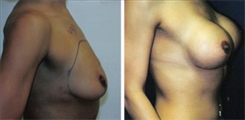 Breast Augmentation Patient Before & After Photo 1