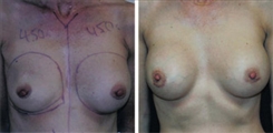 Breast Augmentation Patient Before & After Photo 1