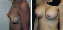 Breast Augmentation Patient Before & After Photo 1