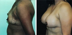 Breast Augmentation Patient Before & After Photo 1