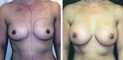 Breast Augmentation Patient Before & After Photo 1