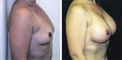 Breast Augmentation Patient Before & After Photo 1