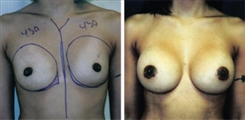 Breast Augmentation Patient Before & After Photo 1