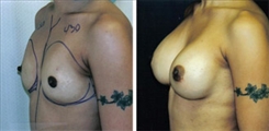 Breast Augmentation Patient Before & After Photo 1