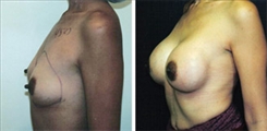 Breast Augmentation Patient Before & After Photo 1