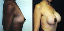 Breast Augmentation Patient Before & After Photo 1