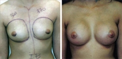 Breast Augmentation Patient Before & After Photo 1