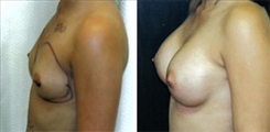 Breast Augmentation Patient Before & After Photo 1