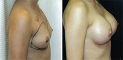 Breast Augmentation Patient Before & After Photo 1