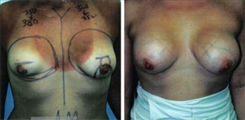 Breast Augmentation Patient Before & After Photo 1