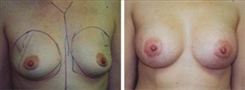 Breast Augmentation Patient Before & After Photo 1