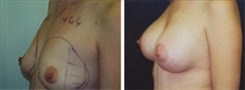 Breast Augmentation Patient Before & After Photo 1