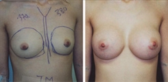 Breast Augmentation Patient Before & After Photo 1