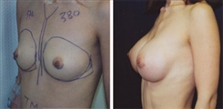 Breast Augmentation Patient Before & After Photo 1