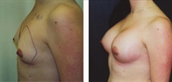 Breast Augmentation Patient Before & After Photo 1