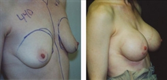 Breast Augmentation Patient Before & After Photo 1