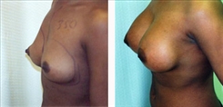 Breast Augmentation Patient Before & After Photo 1