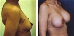 Breast Augmentation Patient Before & After Photo 1