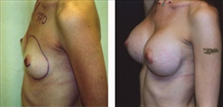 Breast Augmentation Patient Before & After Photo 1