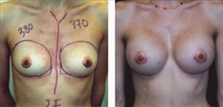 Breast Augmentation Patient Before & After Photo 1