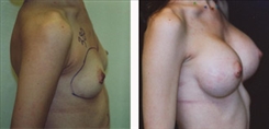 Breast Augmentation Patient Before & After Photo 1