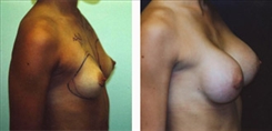 Breast Augmentation Patient Before & After Photo 1