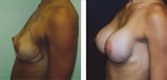 Breast Augmentation Patient Before & After Photo 1